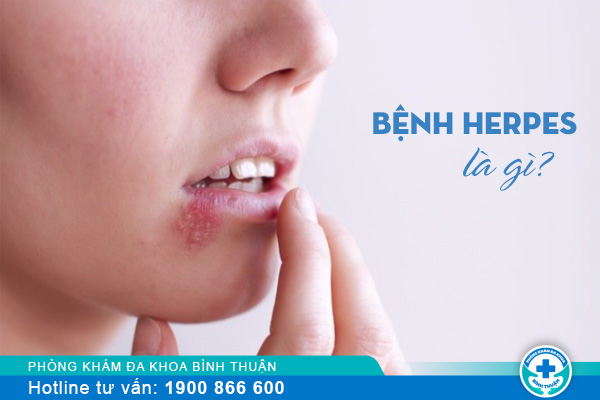 Tìm hiểu bệnh herpes là gì? cách điều trị thế nào?