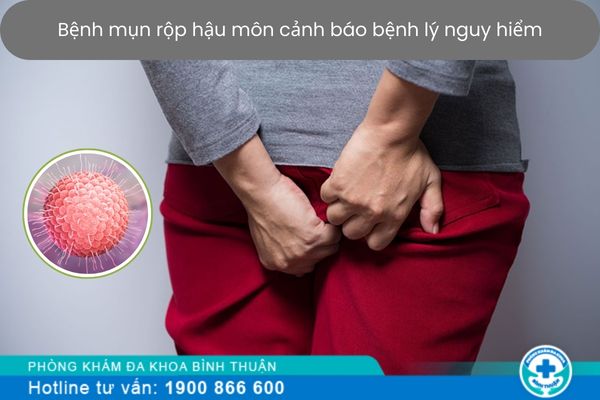 Chớ coi thường bệnh mụn rộp hậu môn - Dấu hiệu cảnh báo bệnh lý nguy hiểm