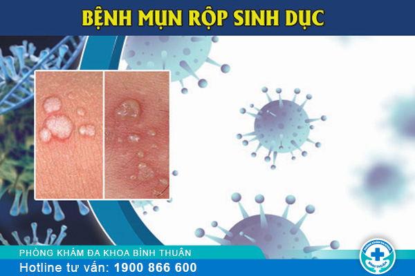 Triệu chứng mụn rộp sinh dục cần lưu ý