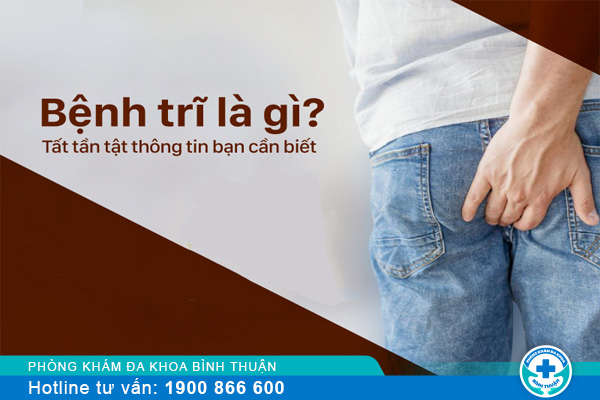 Dấu hiệu bệnh trĩ cấp độ 1,2,3,4 và cách điều trị