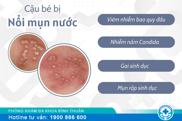 Cậu bé bị nổi mụn nước có đáng lo không?