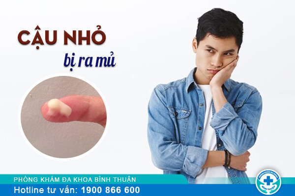 Đừng chủ quan khi nhận thấy cậu nhỏ bị ra mủ