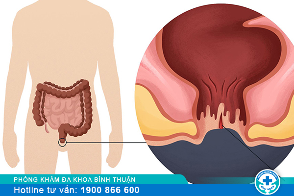 Chi phí chữa rò hậu môn bao nhiêu và nên chữa trị ở đâu hiệu quả?