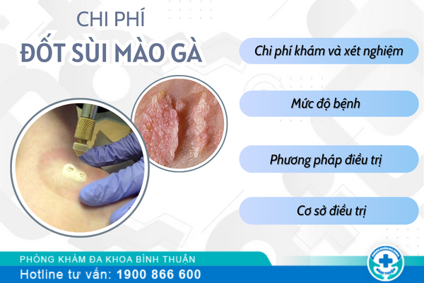 Chi phí đốt sùi mào gà có đắt không?