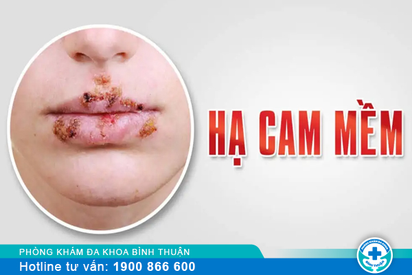 Dấu hiệu bệnh hạ cam, nguyên nhân hạ cam và địa chỉ điều trị