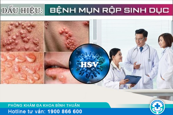 Mụn rộp sinh dục là như thế nào? Điều trị ra sao?