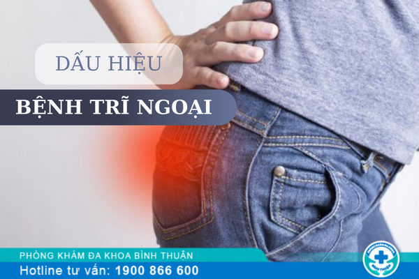 Một số thông tin về bệnh trĩ ngoại