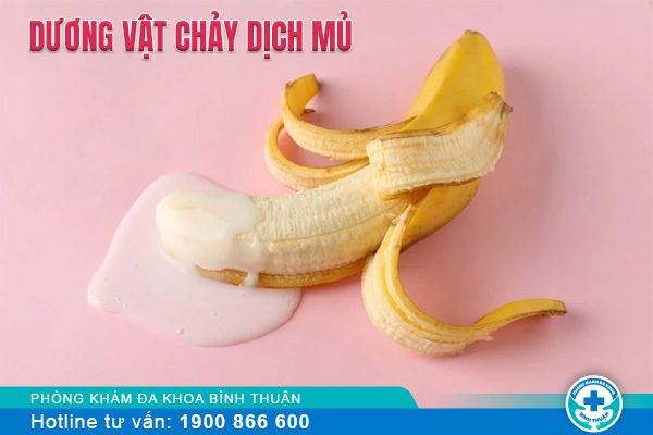 Dương vật chảy dịch mủ là bệnh gì?