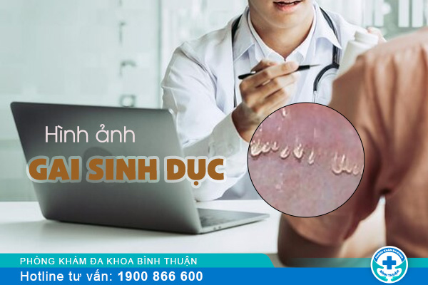 Hình ảnh gai sinh dục dễ nhận biết