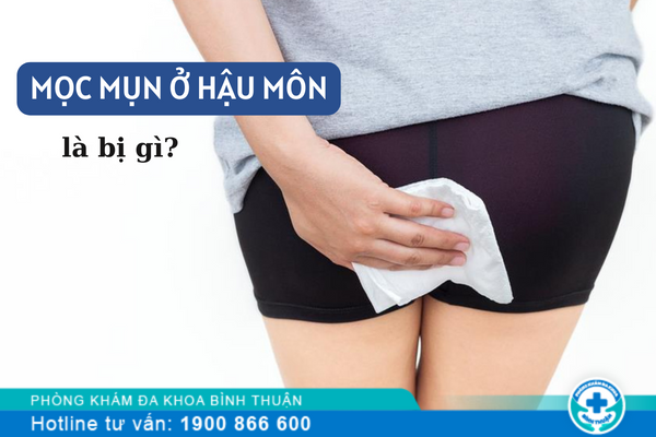 Mọc mụn ở hậu môn là bị gì? có sao không?