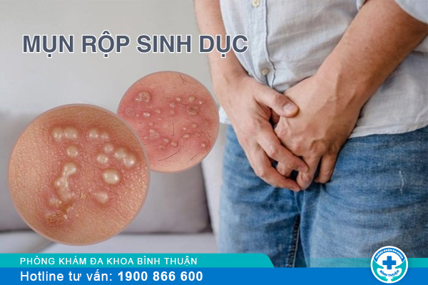 Mụn rộp sinh dục là gì? Cách chữa hiệu quả