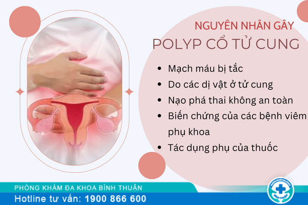 Nguyên nhân, dấu hiệu của bệnh polyp cổ tử cung