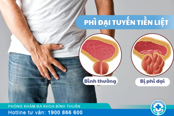 Triệu chứng phì đại tuyến tiền liệt ở nam