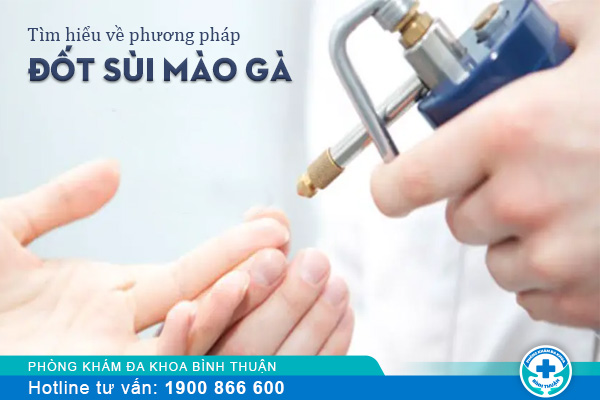 Tìm hiểu về phương pháp đốt sùi mào gà