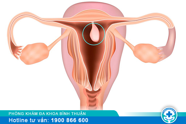 Polyp cổ tử cung có tái phát và điều trị thế nào, ở đâu?