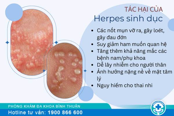 Herpes sinh dục và những tác hại khôn lường