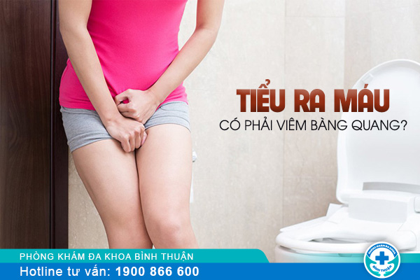 Viêm bàng quang đi tiểu ra máu ở nữ