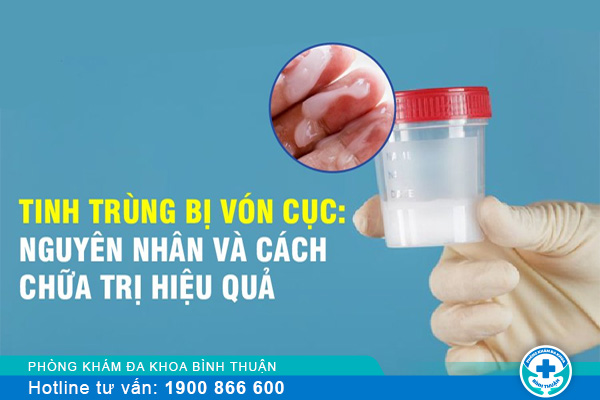 Hình ảnh tinh trùng bị vón cục ra sao?