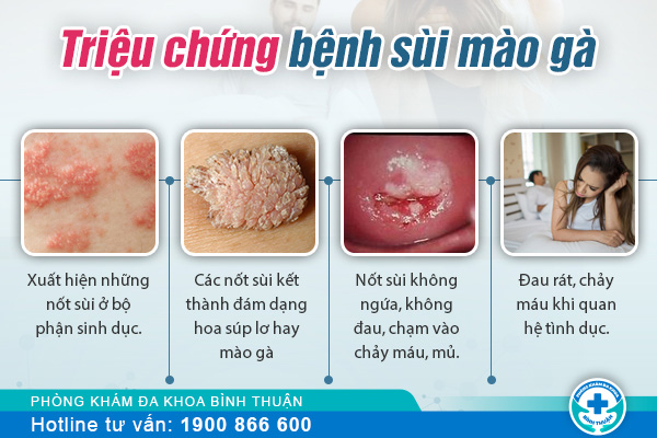 Dấu hiệu sùi mào gà cần lưu ý