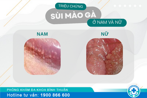 Các triệu chứng sùi mào gà ở nam và nữ