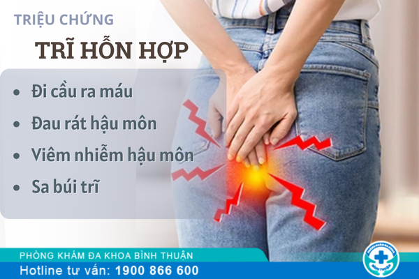 Trĩ hỗn hợp là như thế nào? Cách chữa ra sao?