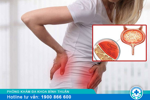 Viêm bàng quang xuất huyết ở nữ điều trị ra sao?