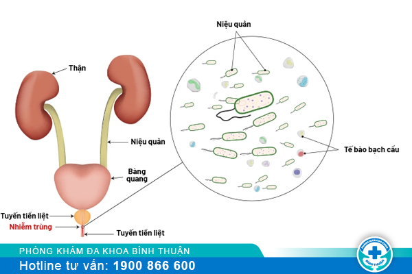 Viêm niệu đạo chữa bao lâu thì hết và chữa ở đâu hiệu quả?